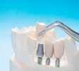 Daytona-Beach-dental-implants