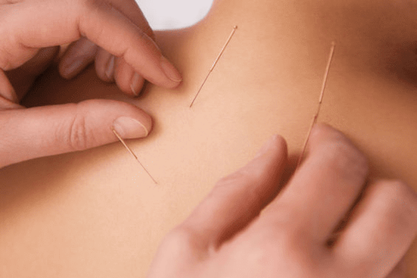 Acupuncture