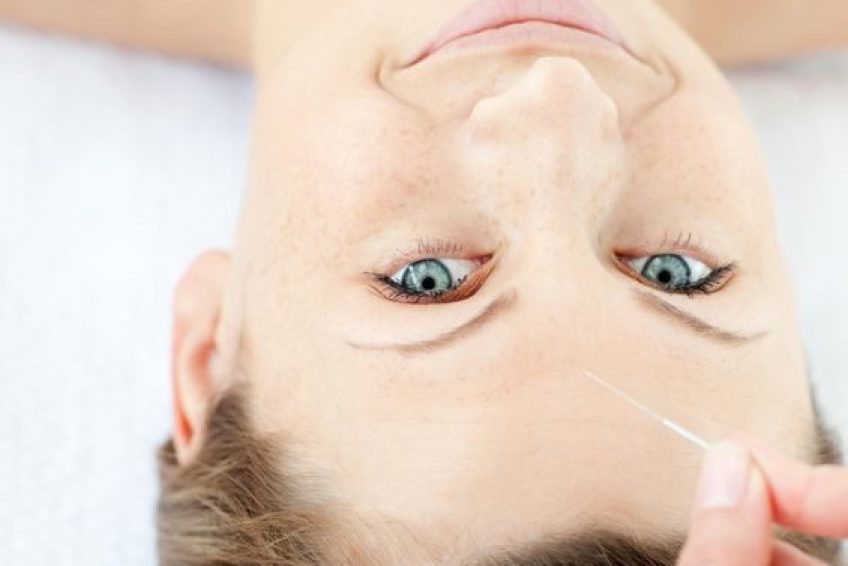 Acupuncture
